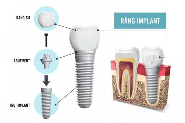 CẤU TẠO RĂNG IMPLANT