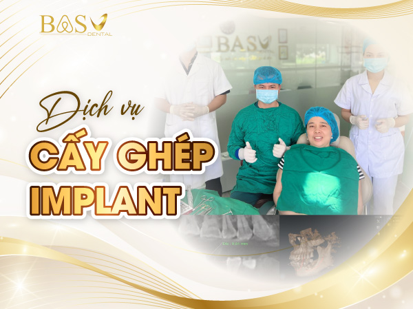Cấy ghép Implant