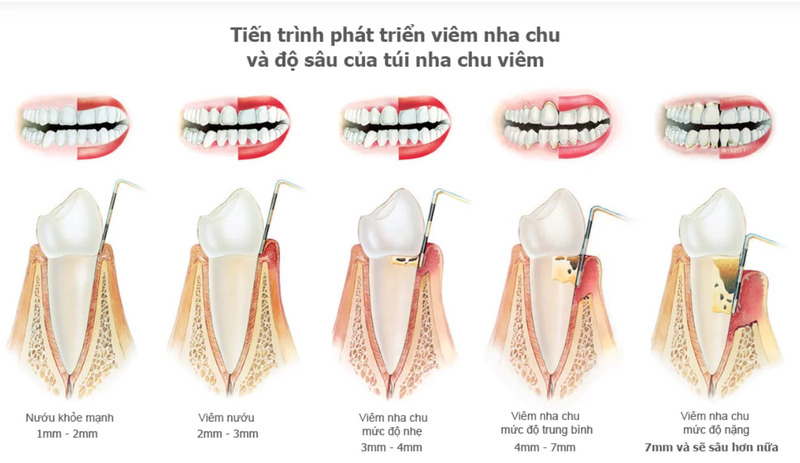 VIÊM NHA CHU LÀ GÌ?